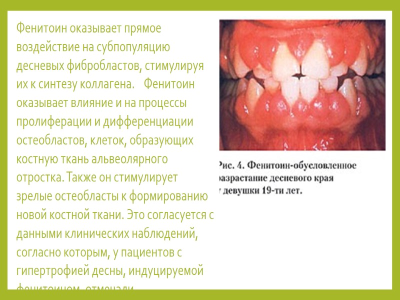 Фенитоин оказывает прямое воздействие на субпопуляцию десневых фибробластов, стимулируя их к синтезу коллагена. 